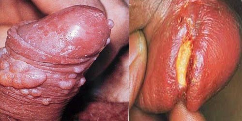 Jual Obat Sipilis De Nature Pengiriman Ke Jambi